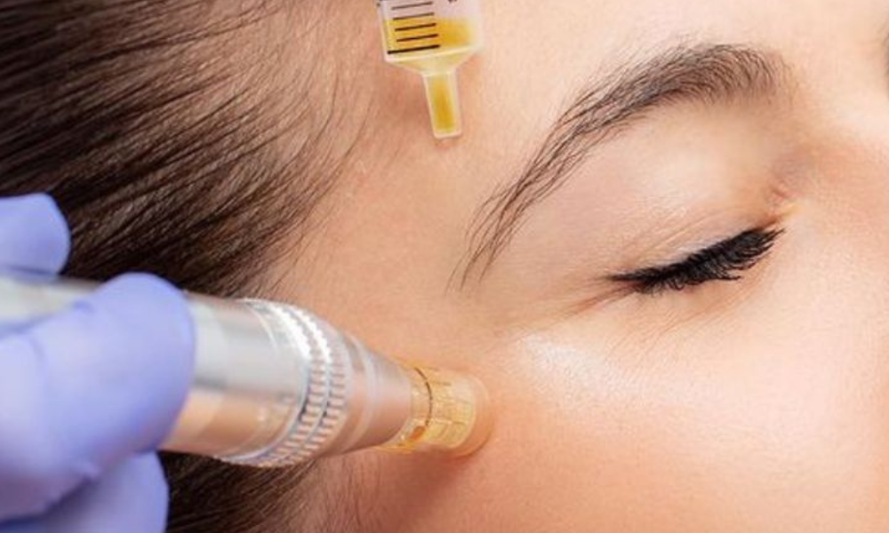 PRP facial before and after