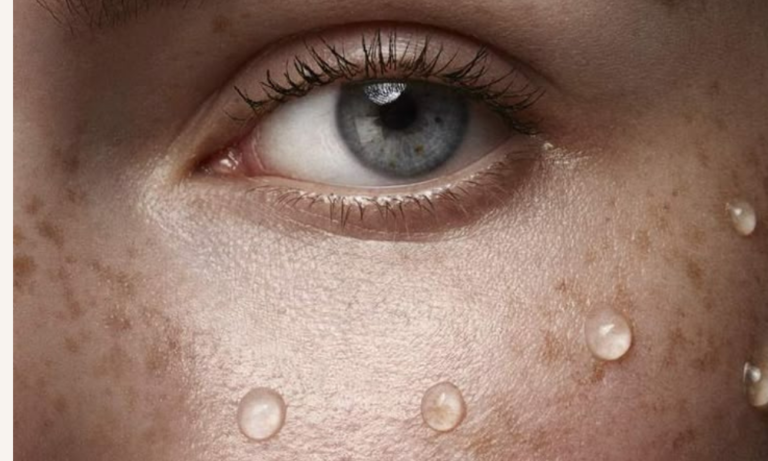 mesotherapy for face