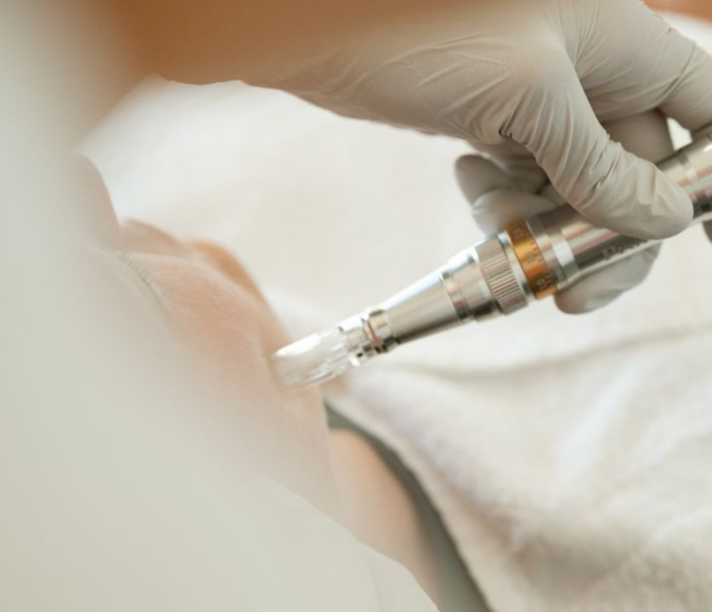Microneedling facial