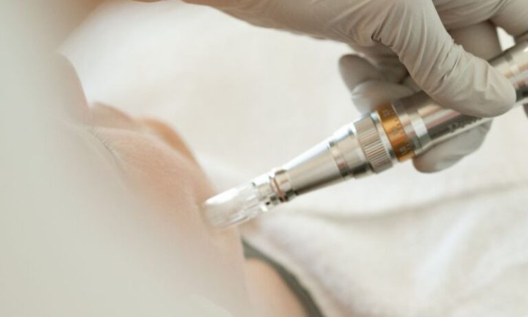 Microneedling facial